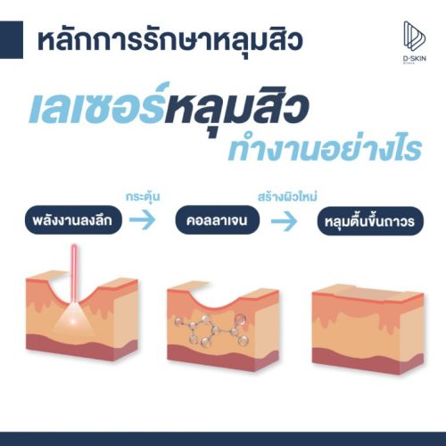 เปรียบเทียบเลเซอร์หลุมสิวปี 2021