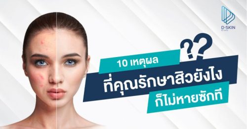 เป็นสิวไม่หายสักทีเกิดจากสาเหตุใด รักษาอย่างไรไม่ให้กลับเป็นสิวซ้ำอีก