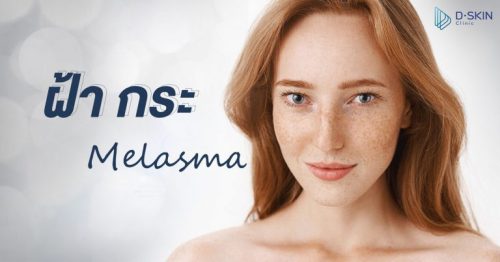 ฝ้า กระ แตกต่างกันอย่างไร รักษายังไงให้จางลง