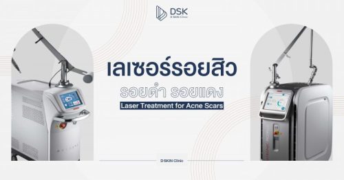 เลเซอร์รอยสิว รอยดำ รอยแดง