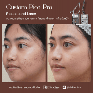 รีวิว, เลเซอร์รอยสิว