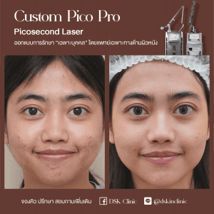 รีวิว, เลเซอร์รอยสิว