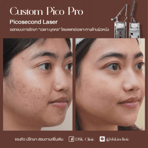 รีวิว, เลเซอร์รอยสิว