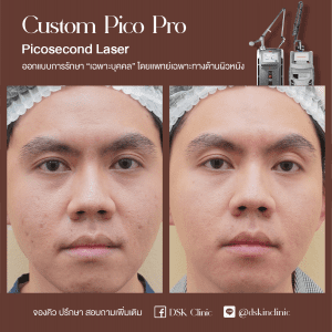 รีวิว, เลเซอร์รอยสิว