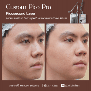 รีวิว, เลเซอร์รอยสิว