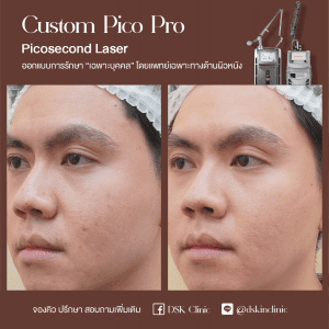 รีวิว, เลเซอร์รอยสิว