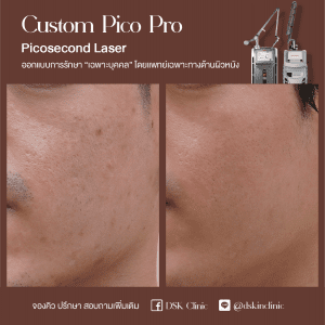 รีวิว, เลเซอร์รอยสิว