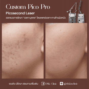 รีวิว, เลเซอร์รอยสิว