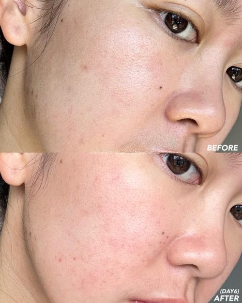 รวมรีวิว Picosecond Laser ที่ DSK Clinic