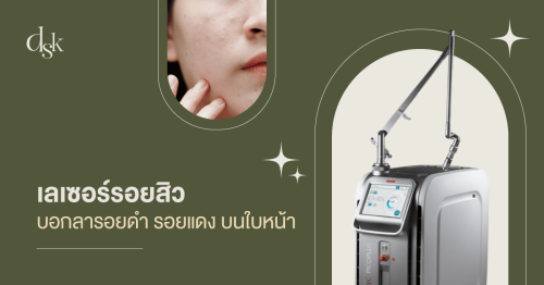 เลเซอร์รอยสิว บอกลารอยดำ รอยแดง บนใบหน้า