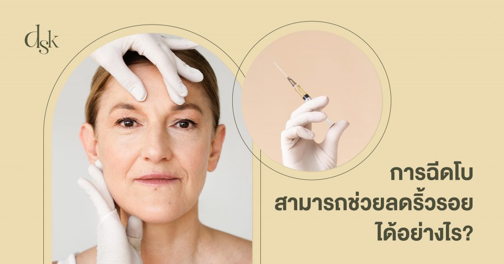 การฉีดโบคืออะไร สามารถช่วยลดริ้วรอยได้อย่างไร