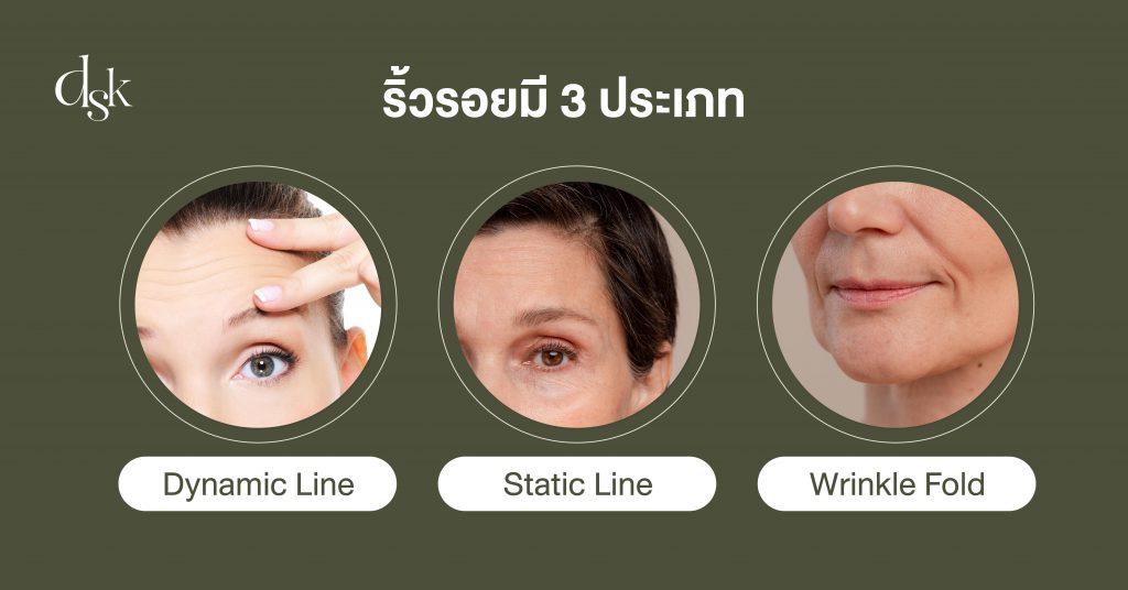 ริ้วรอยมีกี่ประเภท