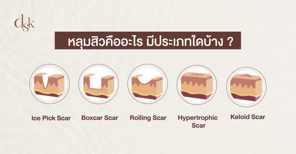 หลุมสิวคืออะไร มีประเภทใดบ้าง ?