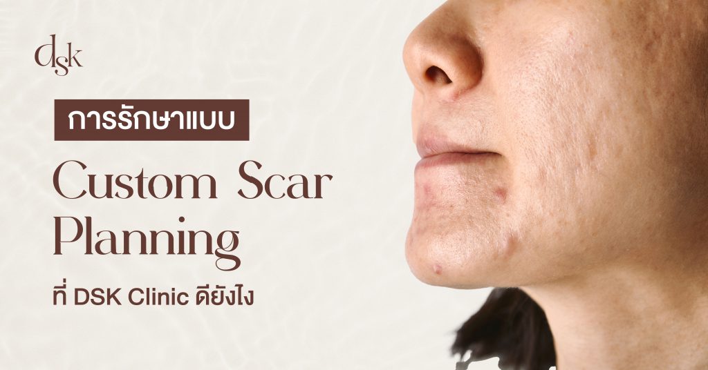 การรักษาแบบ Custom Scar Planning