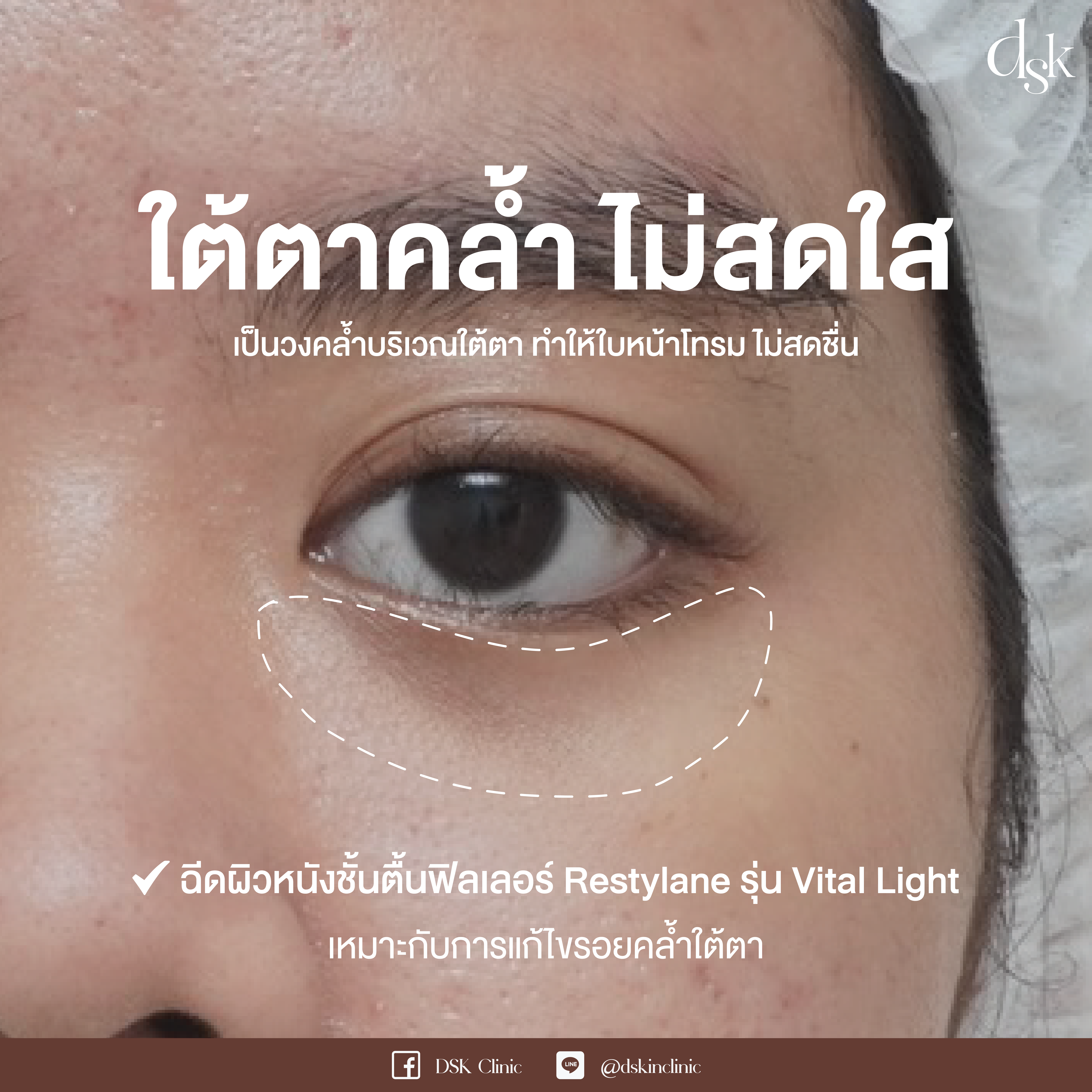 ใต้ตาดำคล้ำจากภูมิแพ้ แก้ไขได้ด้วยฟิลเลอร์ เฉพาะที่ DSK