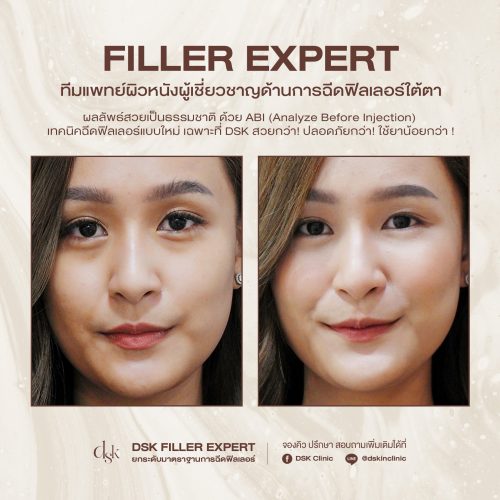 รวมรีวิวฟิลเลอร์ใต้ตา ที่ DSK Filler & Lifting Excellence Center