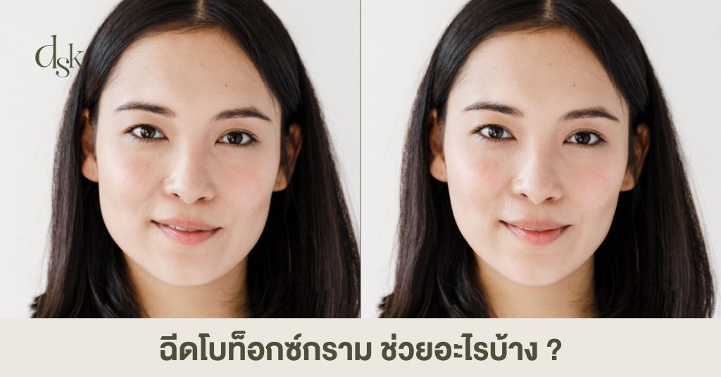 ฉีดโบท็อกซ์กราม ช่วยอะไรบ้าง ?