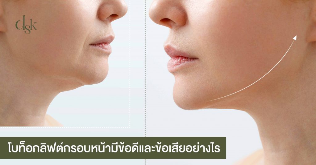 โบท็อกซ์ลิฟต์กรอบหน้ามีข้อดี และข้อเสียอย่างไร