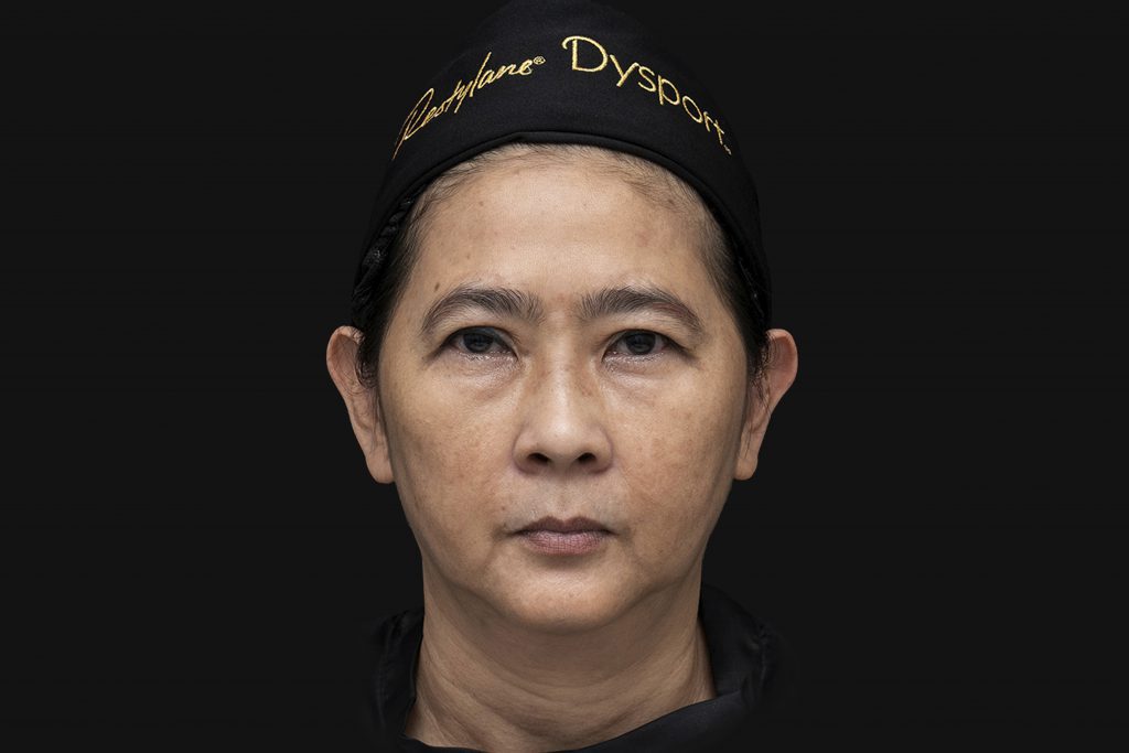 เคสคนไทยอายุ 53 ปี ฉีด Sculptra ทั้งหมด 5 ขวด