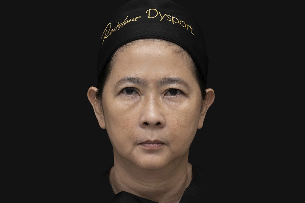 เคสคนไทยอายุ 53 ปี ฉีด Sculptra ทั้งหมด 5 ขวด