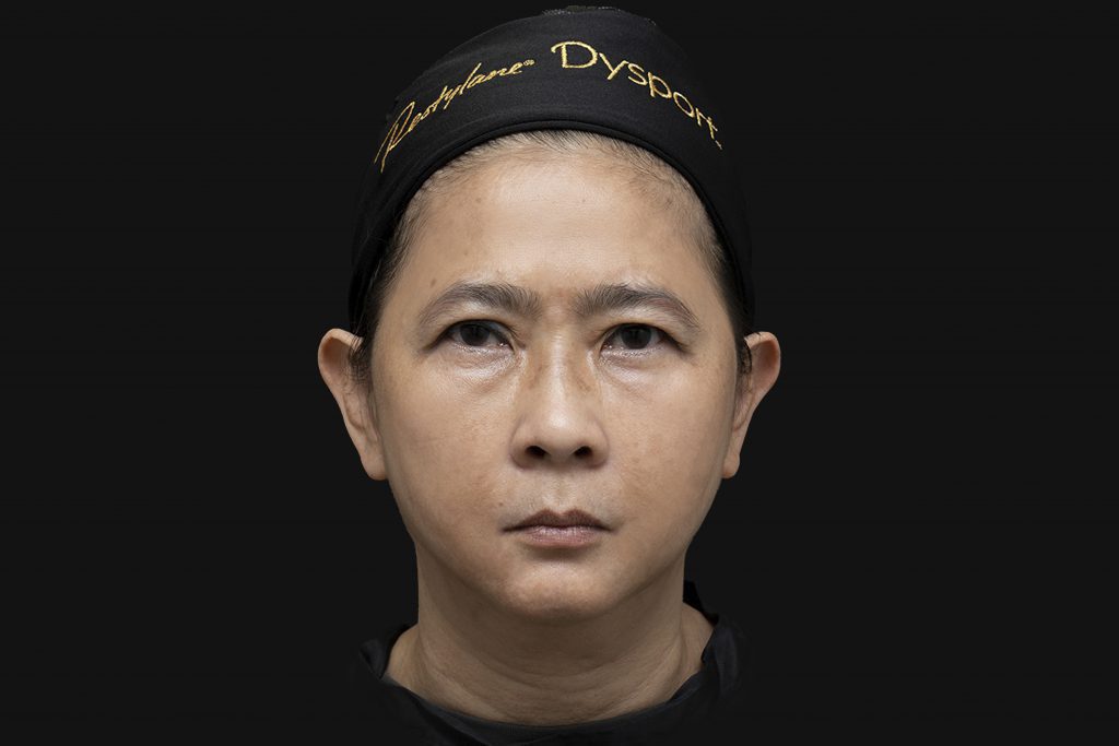 เคสคนไทยอายุ 53 ปี ฉีด Sculptra ทั้งหมด 5 ขวด