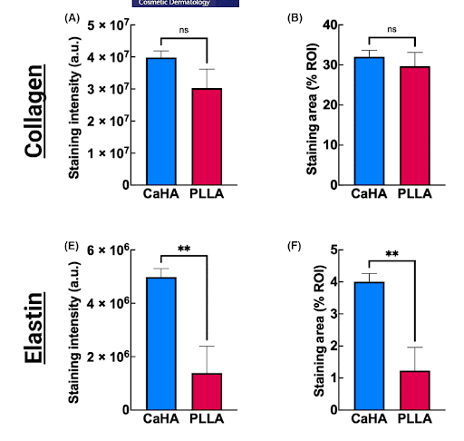 Sculptra VS. Radiesse