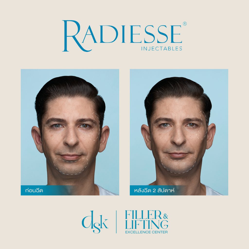 Radiesse, DSK clinic