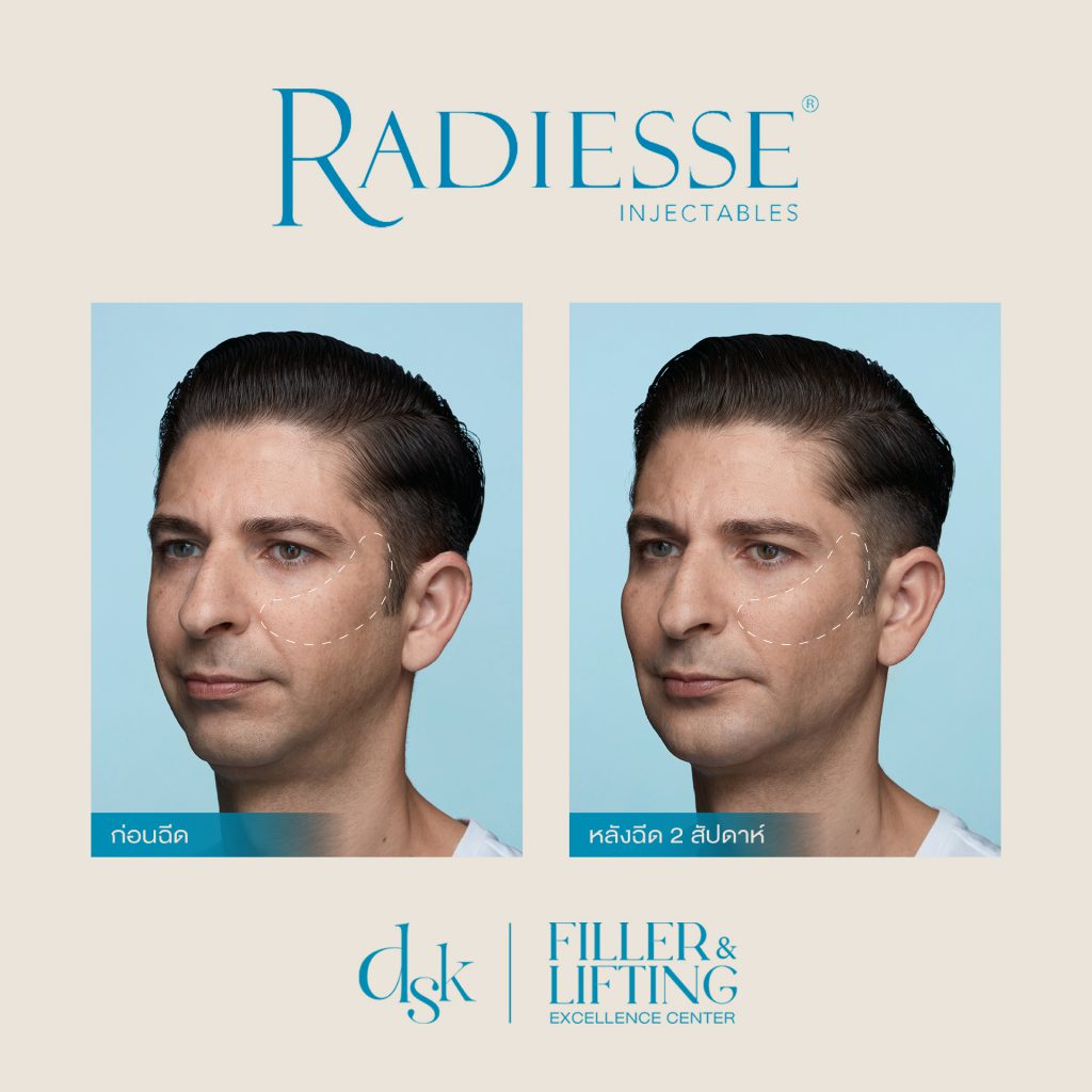 Radiesse, DSK clinic