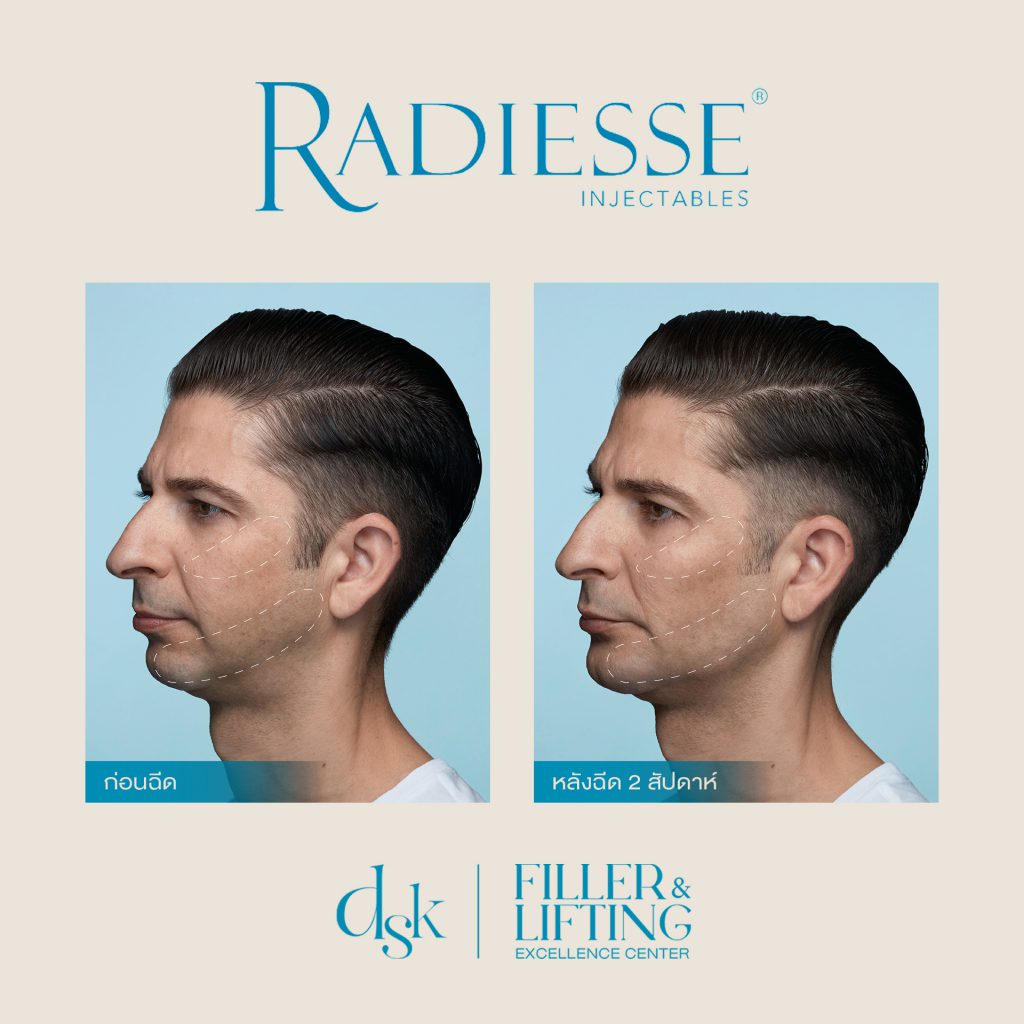 Radiesse, DSK clinic