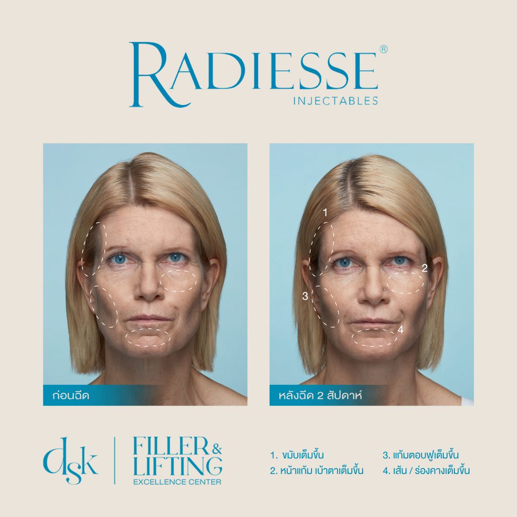 Radiesse, DSK clinic