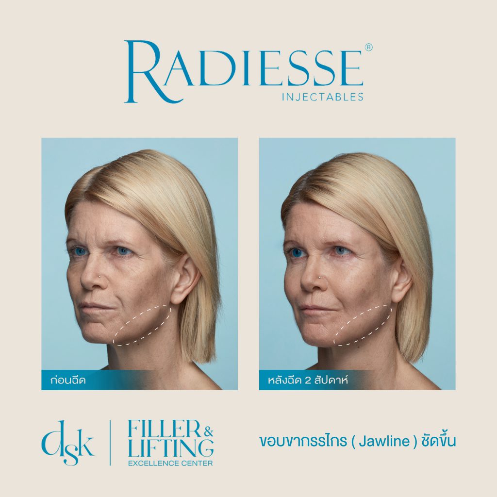 Radiesse, DSK clinic