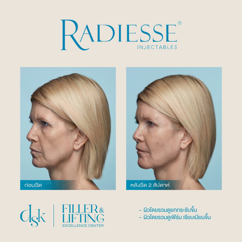 Radiesse, DSK clinic