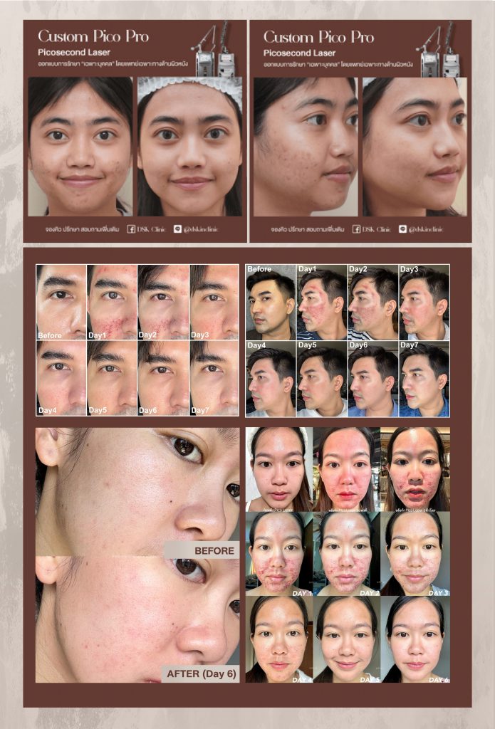 รีวิว Picosecond Laser ที่ DSK Clinic