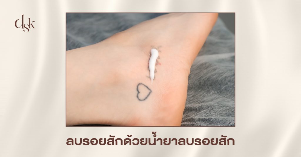 ลบรอยสักด้วยน้ำยาลบรอยสัก