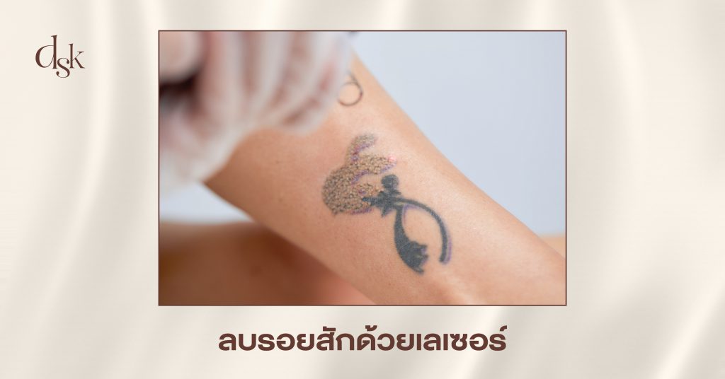 ลบรอยสักด้วยเลเซอร์