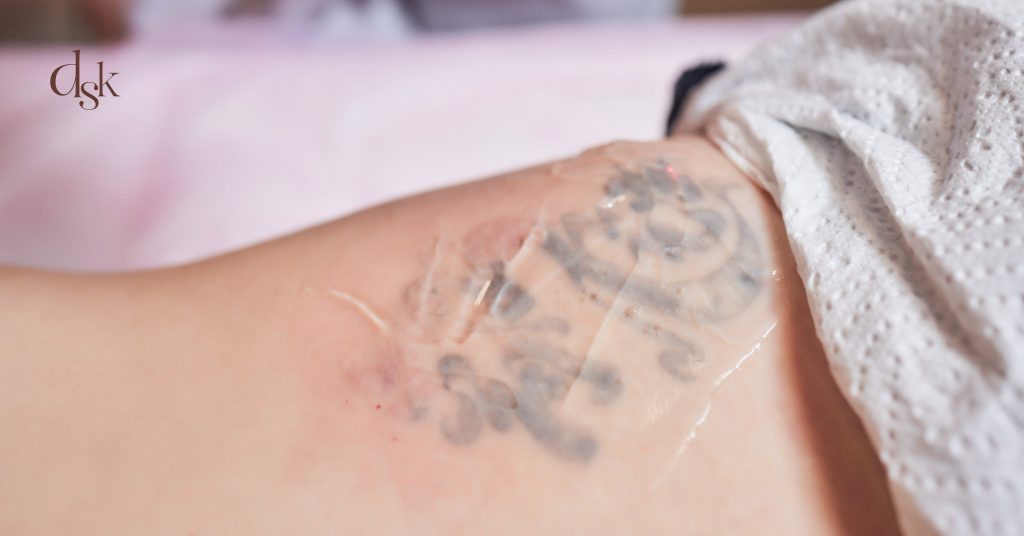 ขั้นตอนการลบรอยสักด้วย Picosecond Laser