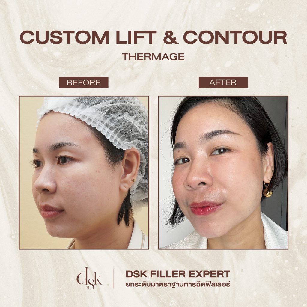 รีวิว Thermage ที่ DSK Clinic