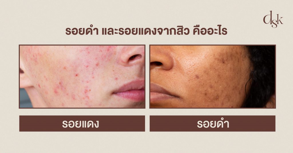 รอยดำ และรอยแดงจากสิว คืออะไร