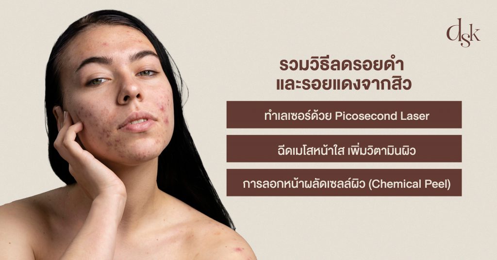 รวมวิธีลดรอยดำ และรอยแดงจากสิว