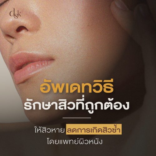 อัพเดทวิธีรักษาสิวที่ถูกต้อง ให้สิวหายลดการเกิดสิวซ้ำโดยแพทย์ผิวหนัง