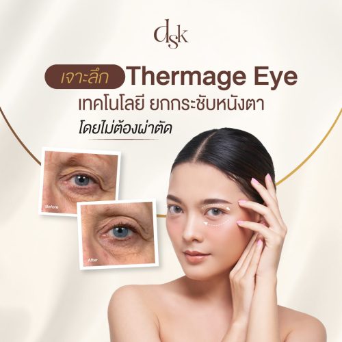 เจาะลึก Thermage Eye เทคโนโลยียกกระชับหนังตา ไม่ผ่าตัดไม่พักฟื้น