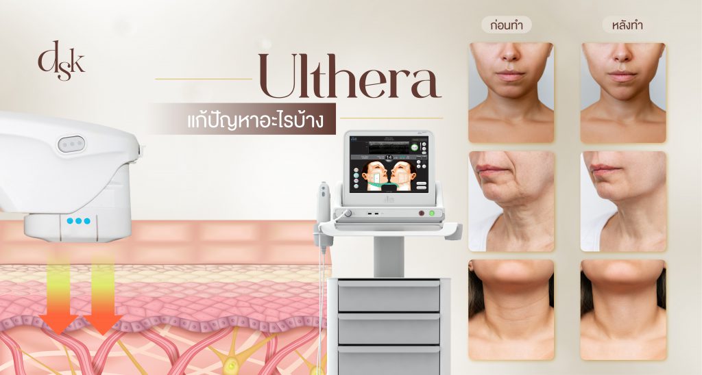 Ulthera แก้ปัญหาอะไรบ้าง
