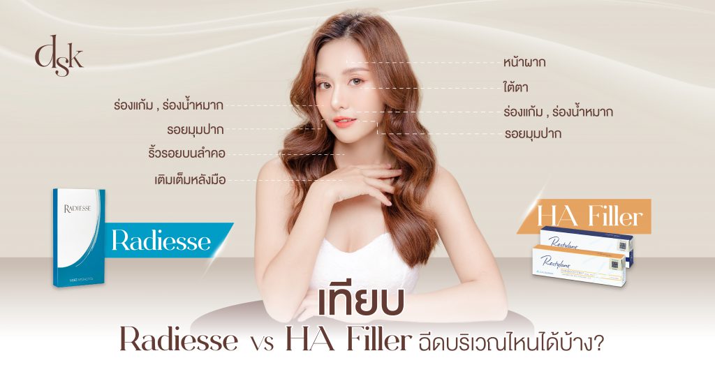 เทียบ Radiesse VS HA Filler ฉีดบริเวณไหนได้บ้าง?