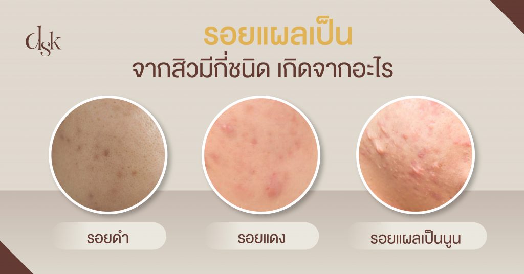 รอยแผลเป็นจากสิวมีกี่ชนิด เกิดจากอะไร