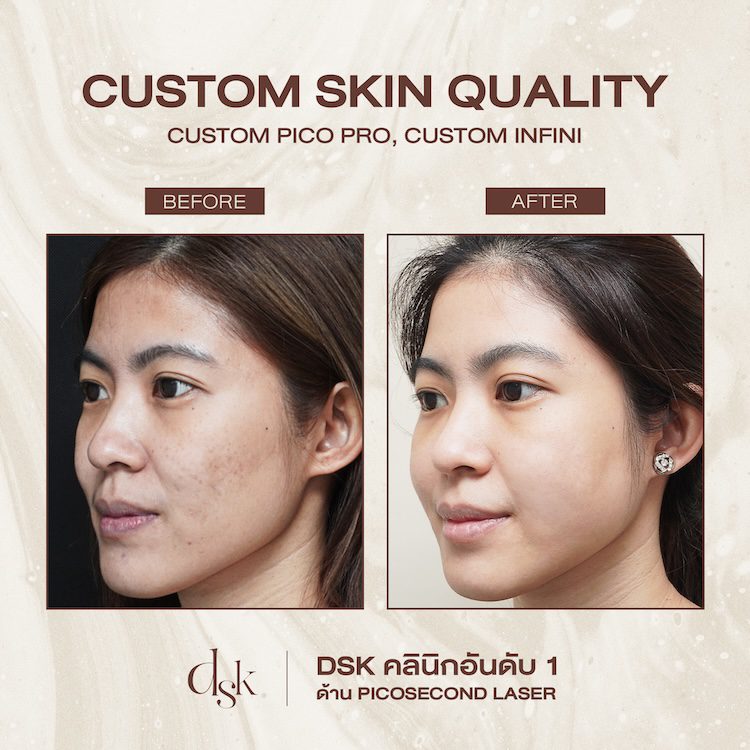 รีวิวการรักษารอยแผลเป็นจากสิว