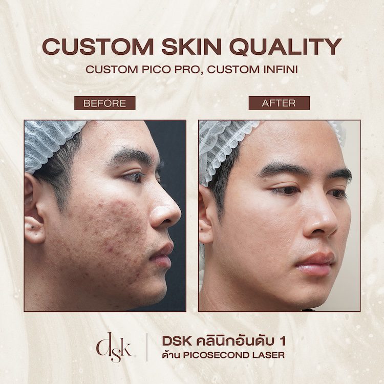 รีวิวการรักษารอยแผลเป็นจากสิว