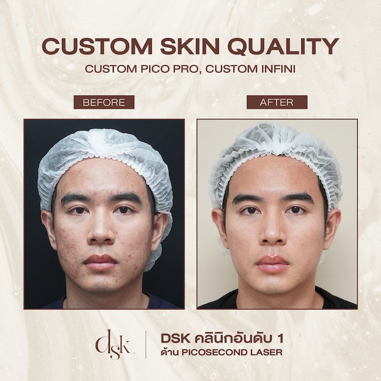 รีวิวการรักษารอยแผลเป็นจากสิว