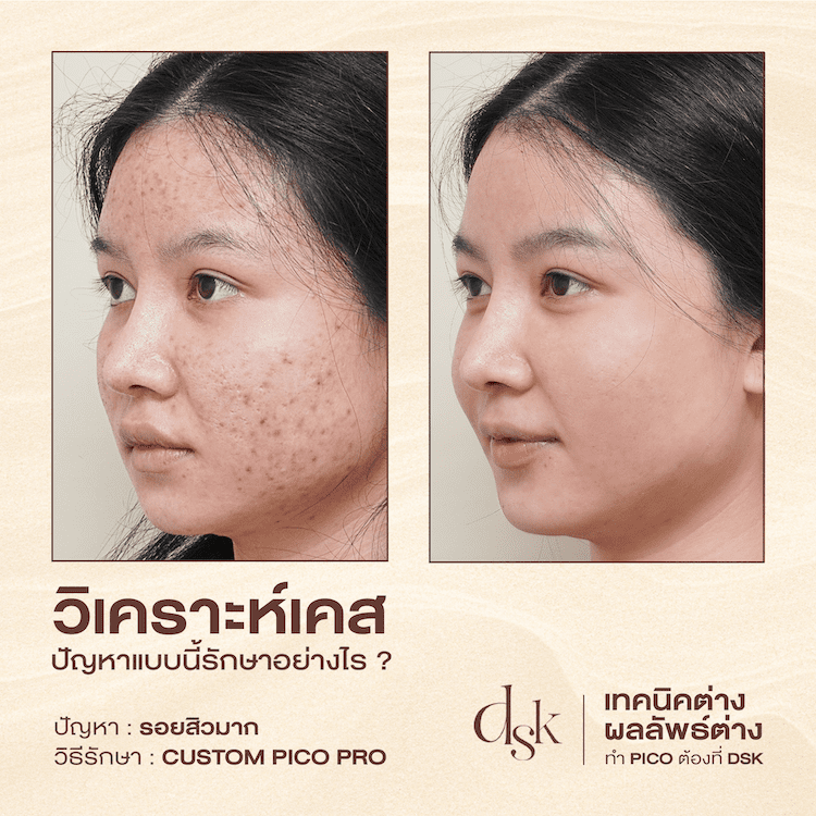 รีวิวการรักษารอยแผลเป็นจากสิว