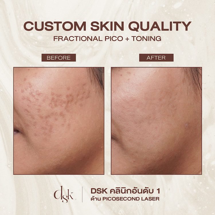 รีวิวการรักษารอยแผลเป็นจากสิว