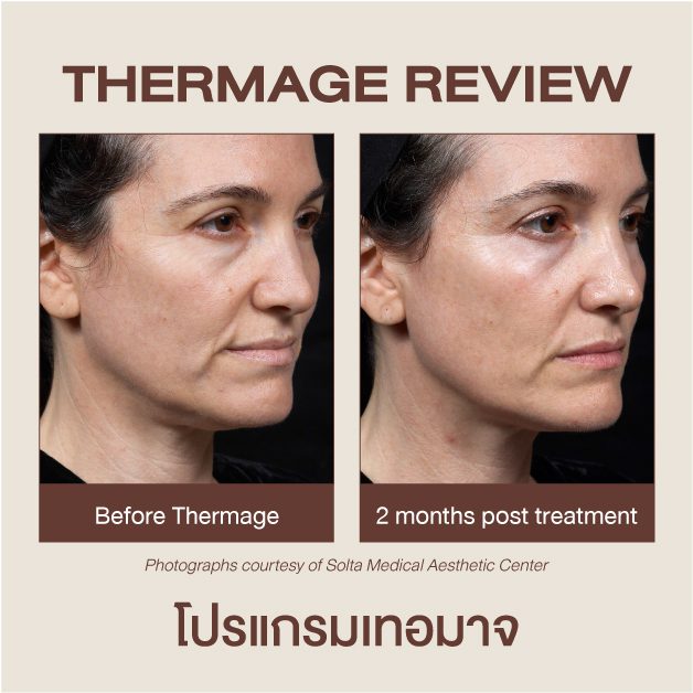 รีวิว Ulthera กับ Thermage ที่ DSK Clinic